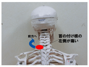 痛い 首 の 付け根